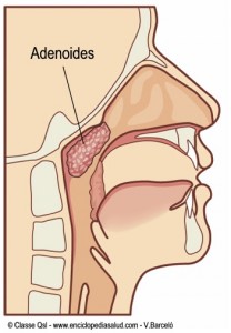 Adenoides,  amígdalas faríngeas, vegetaciones